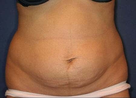 Tummy Tuck Before & After