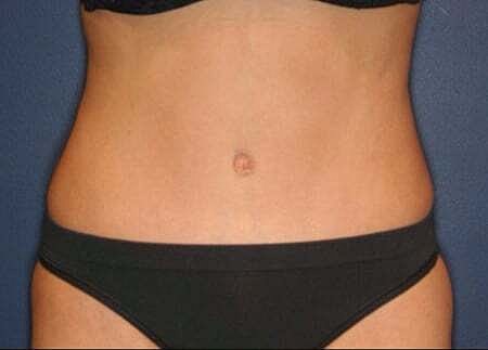 Tummy Tuck Before & After