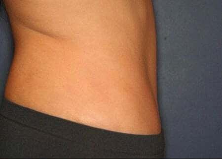 Tummy Tuck Before & After
