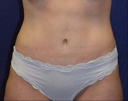 Tummy Tuck Before & After