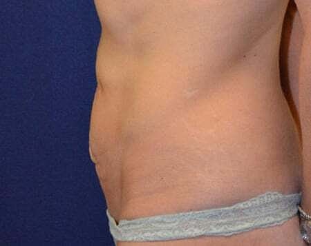 Tummy Tuck Before & After