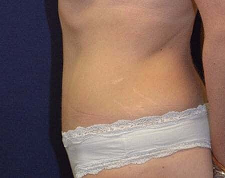 Tummy Tuck Before & After