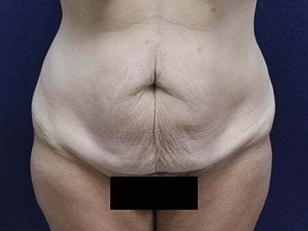 Tummy Tuck Before & After