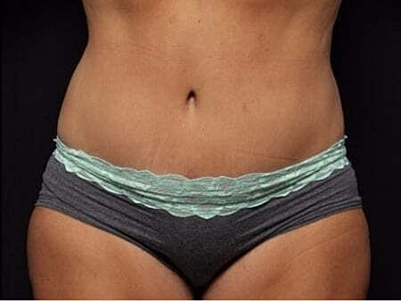 Tummy Tuck Before & After