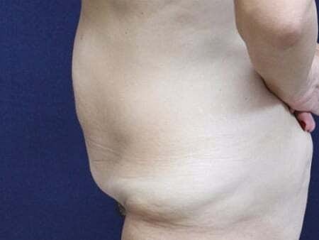 Tummy Tuck Before & After