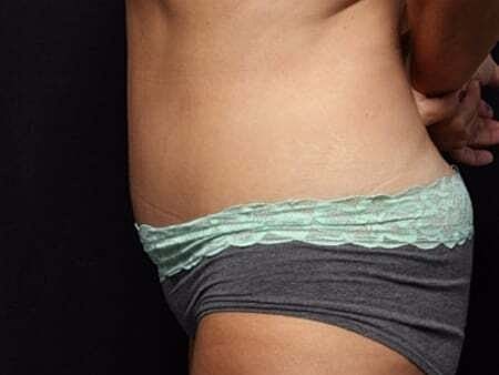 Tummy Tuck Before & After