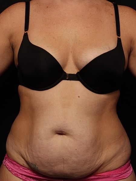 Tummy Tuck Before & After