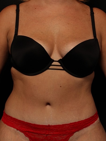 Tummy Tuck Before & After
