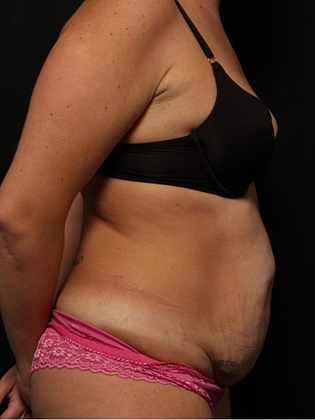 Tummy Tuck Before & After