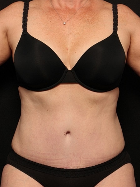 Tummy Tuck Before & After