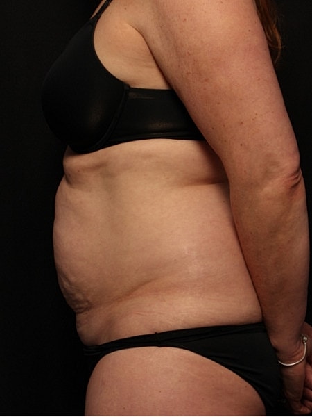 Tummy Tuck Before & After
