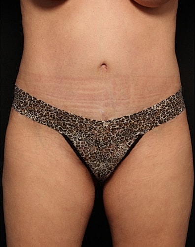 Tummy Tuck Before & After