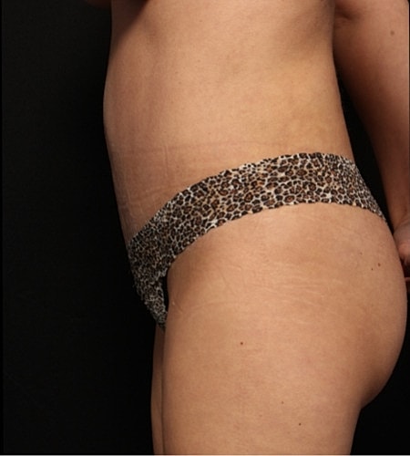 Tummy Tuck Before & After
