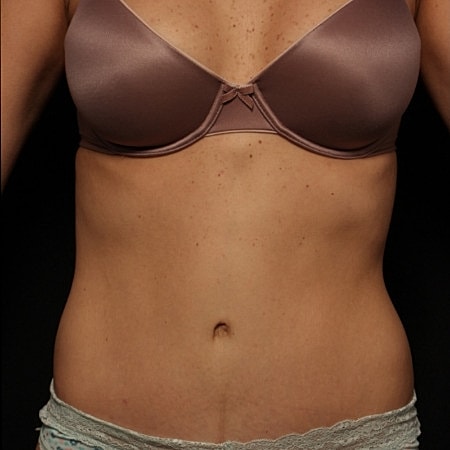 Tummy Tuck Before & After
