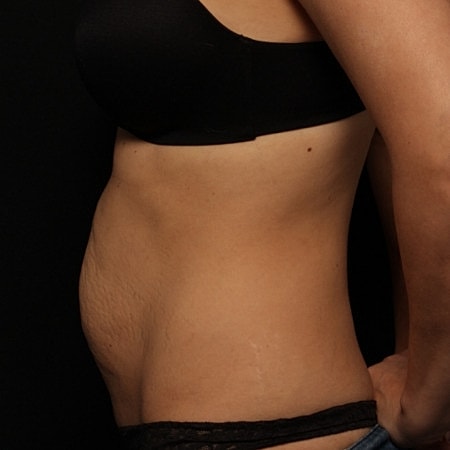 Tummy Tuck Before & After