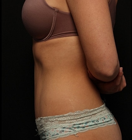Tummy Tuck Before & After