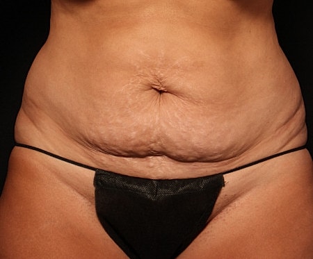 Tummy Tuck Before & After