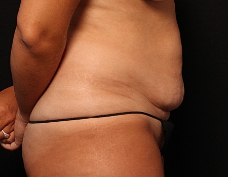Tummy Tuck Before & After
