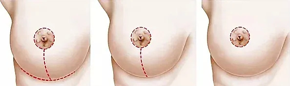 Breast anatomy illustration showing different positions.