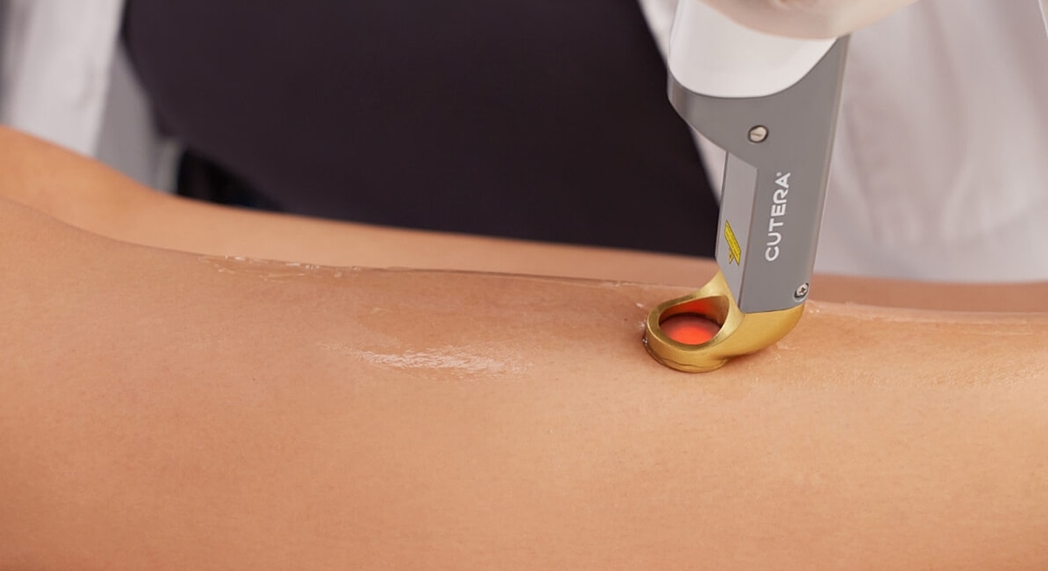 Laser treatment on skin for skincare procedure.