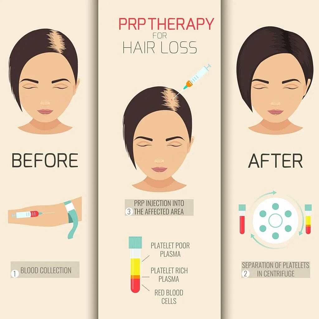 Hair Restoration with Plasma
