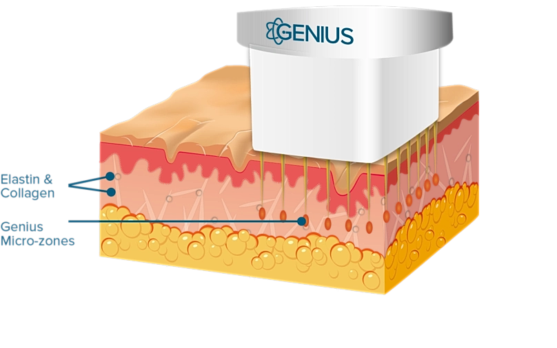 Skin layering with Genius micro-zones treatment illustration.