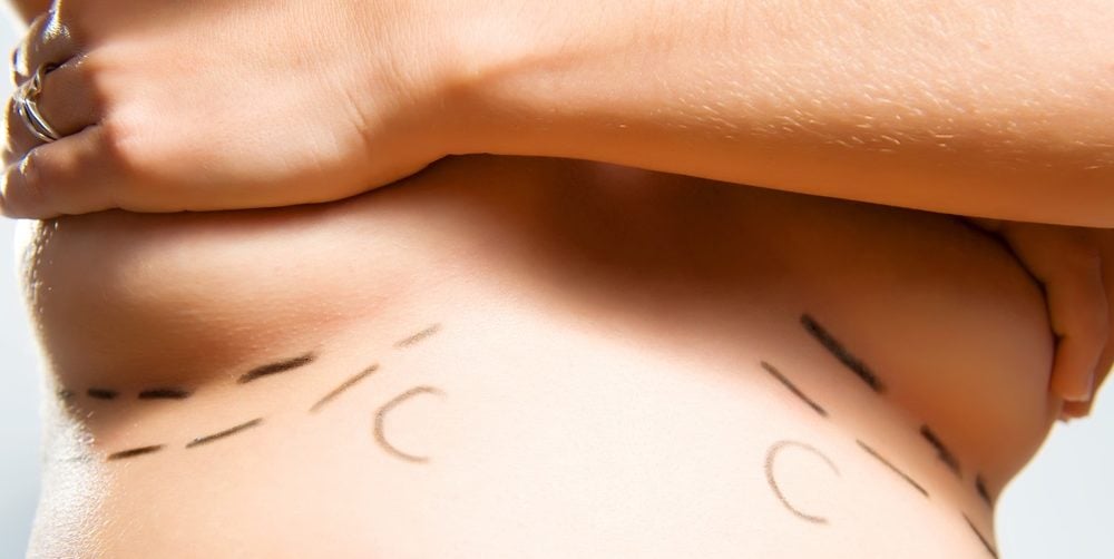 breast surgery
